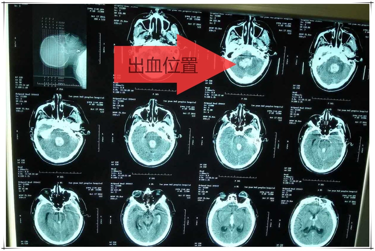 燕某術(shù)前CT_看圖王.jpg