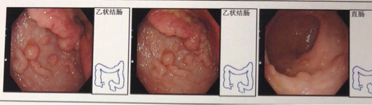 乙狀結(jié)腸黏膜病理檢查2.png