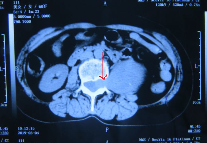 術前CT   箭頭所指腫塊經(jīng)椎間孔進入椎管.png
