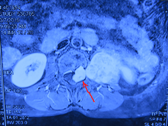 術前MRI水平位  箭頭所指為腫塊，腫塊進入椎管2.png