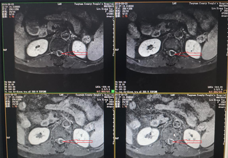 001-術(shù)前MRI，箭頭所指即椎管內(nèi)腫瘤.png